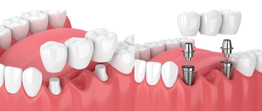 Side by side comparison of a bridge on natural teeth vs. an implant-supported bridge to replace missing teeth