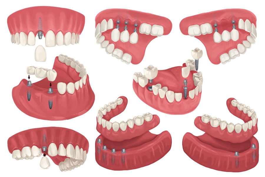 Collection of drawings depicting different configurations of dental implants in a patient's mouth in Westerville, OH