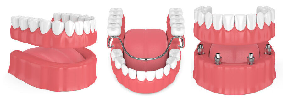 3 types of dentures: partial dentures, removable full dentures, and implant-supported dentures