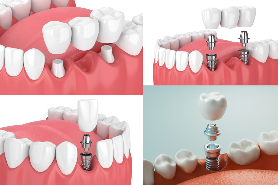 4 images showing dental implants and bridges to replace teeth