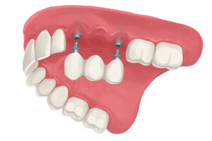 Implant-supported dental bridge to replace missing teeth