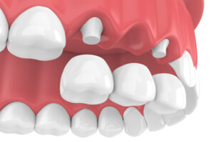 tooth-supported fixed bridge to replace a missing tooth