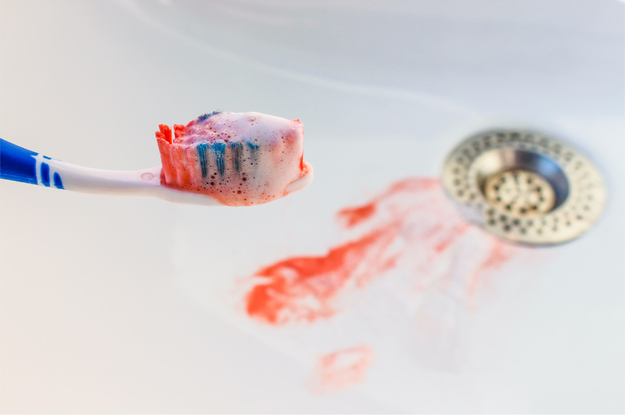 Closeup of a sink and toothbrush with blood from bleeding gums due to gum disease