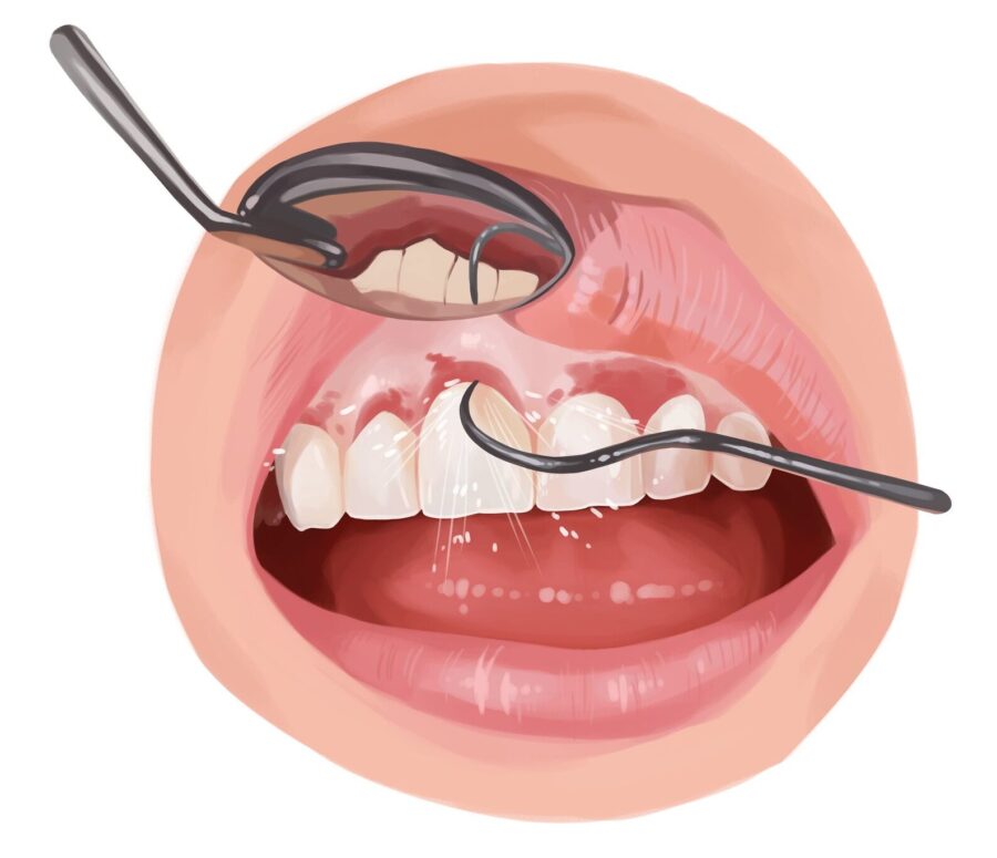 Closeup of a patient receiving a deep cleaning to address their inflamed gums due to gum disease