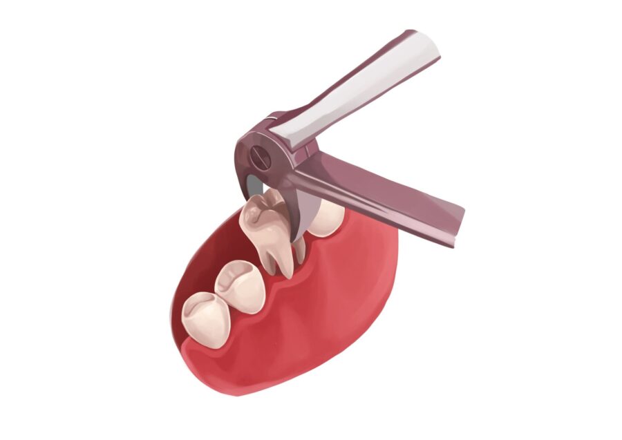 Illustration of special dental tools extracting an adult tooth