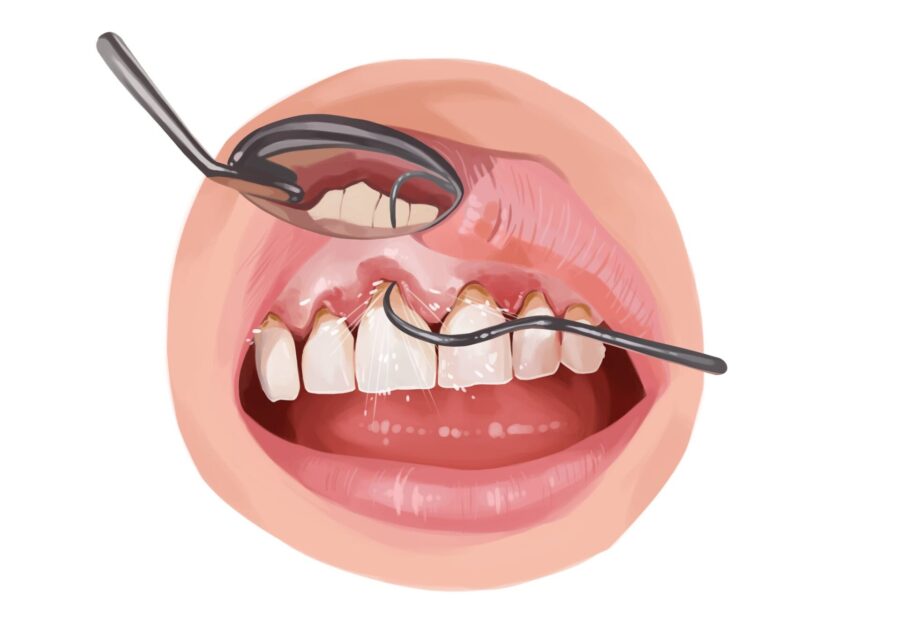 closeup illustration of dental tools cleaning periodontal pockets from gum disease
