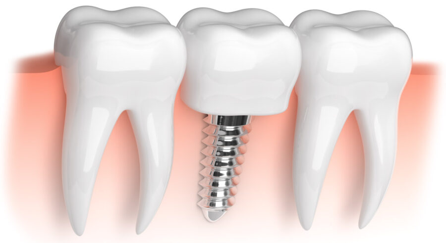 Closeup of a dental implant to replace a missing tooth