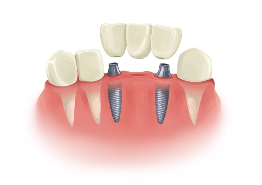 Illustration of an implant-supported dental bridge